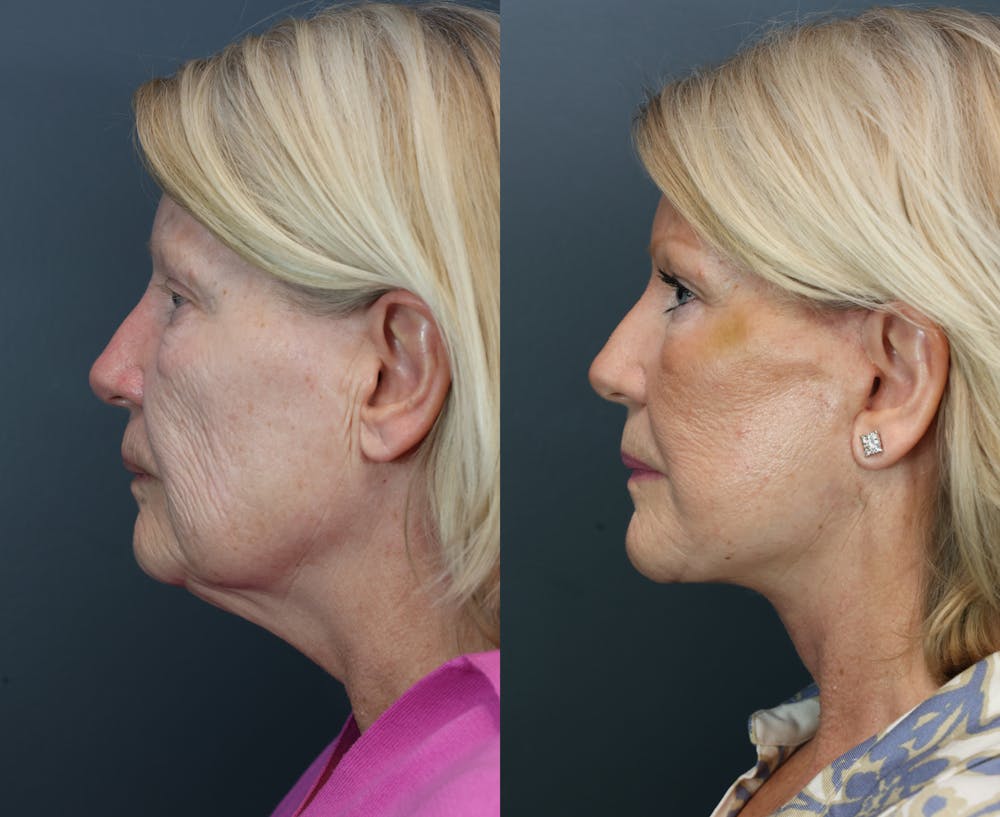 Brow Lift (Forehead Lift) Before & After Gallery - Patient 281857 - Image 4