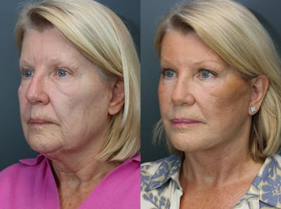 Deep Plane Facelift Before & After Gallery - Patient 248628 - Image 1