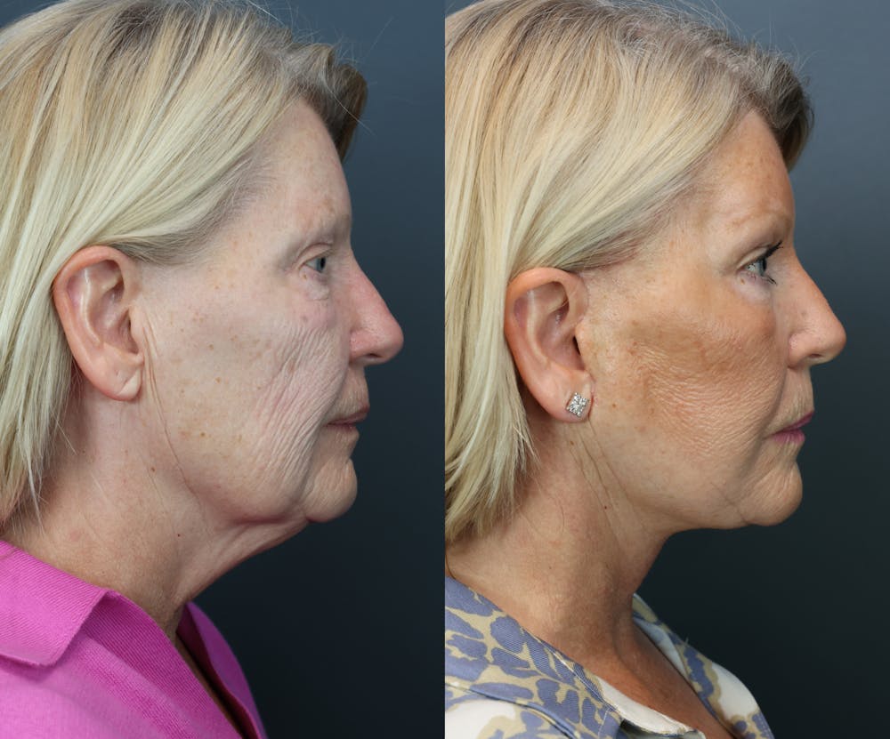 Brow Lift (Forehead Lift) Before & After Gallery - Patient 281857 - Image 5