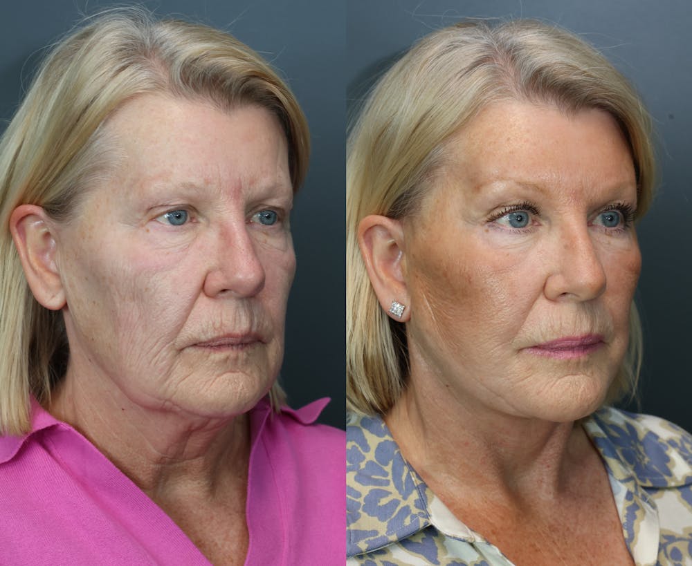 Brow Lift (Forehead Lift) Before & After Gallery - Patient 281857 - Image 2