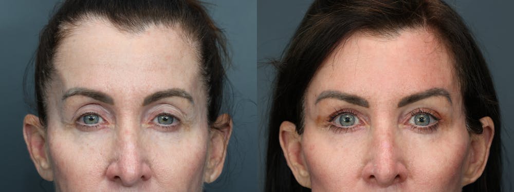 Eyelid Surgery Before & After Gallery - Patient 541129 - Image 1