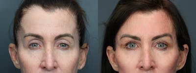 Eyelid Surgery Before & After Gallery - Patient 541129 - Image 1
