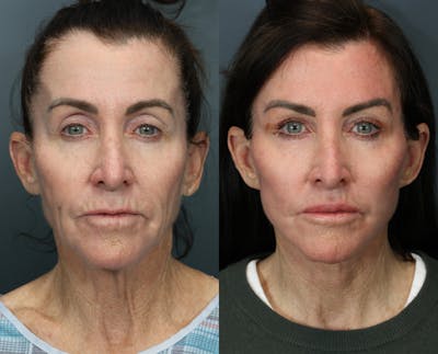 Deep Plane Facelift Before & After Gallery - Patient 384235 - Image 1
