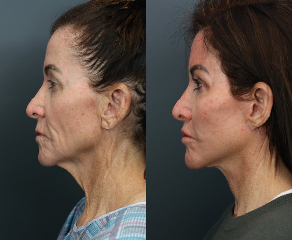 Deep Plane Facelift Before & After Gallery - Patient 384235 - Image 2