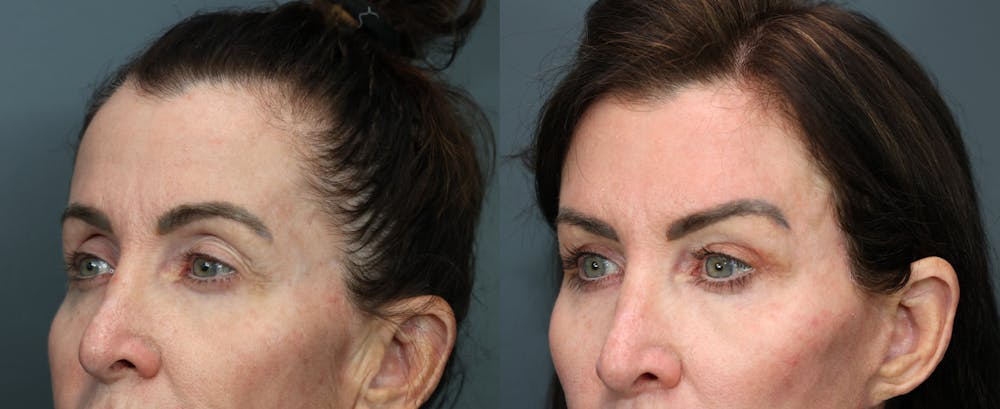 Eyelid Surgery Before & After Gallery - Patient 541129 - Image 2