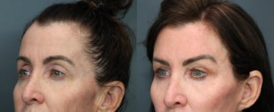 Eyelid Surgery Before & After Gallery - Patient 541129 - Image 2