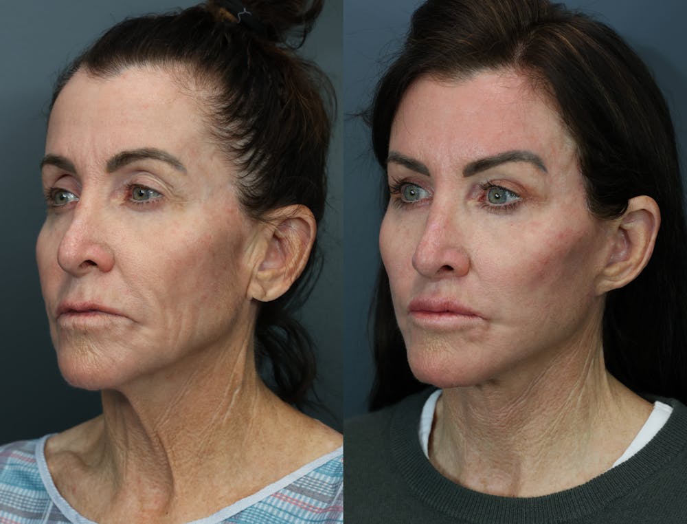 Deep Plane Facelift Before & After Gallery - Patient 384235 - Image 3