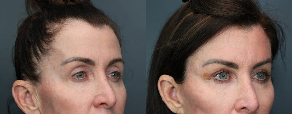 Eyelid Surgery Before & After Gallery - Patient 541129 - Image 3