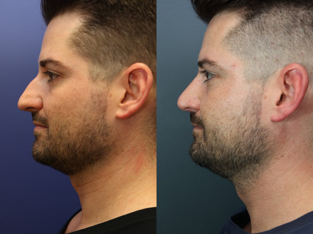 Rhinoplasty (Nose Reshaping) Before & After Gallery - Patient 365233 - Image 3