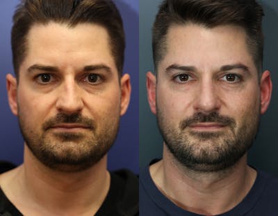 Rhinoplasty (Nose Reshaping) Before & After Gallery - Patient 365233 - Image 1