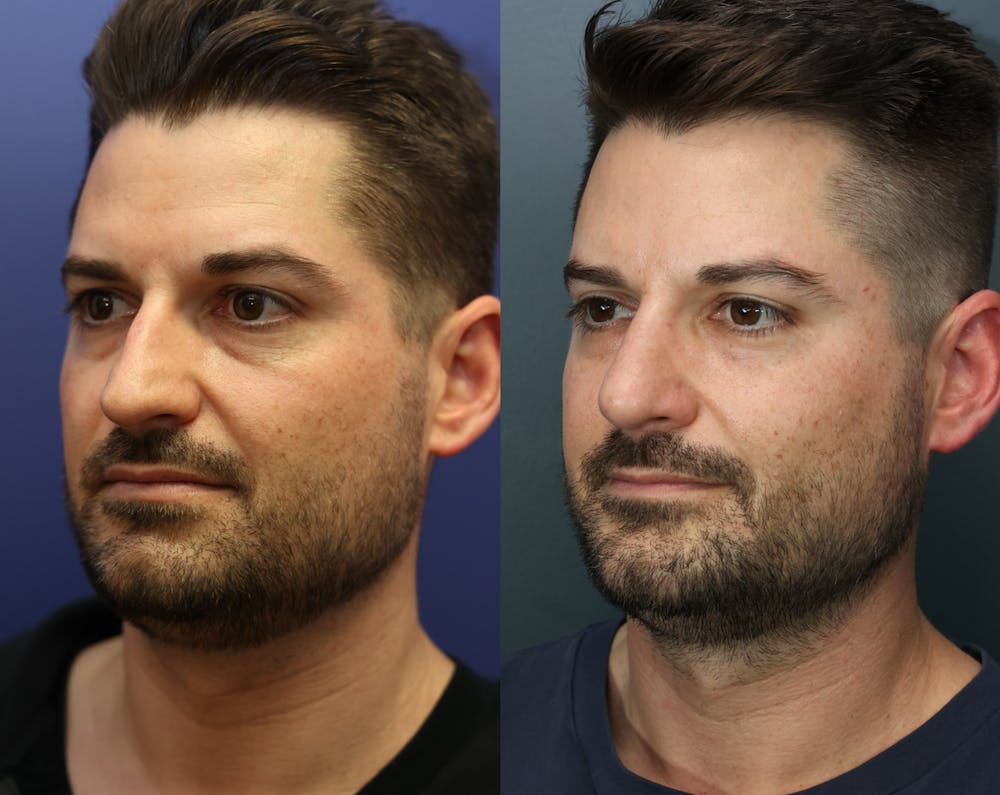 Rhinoplasty (Nose Reshaping) Before & After Gallery - Patient 365233 - Image 2