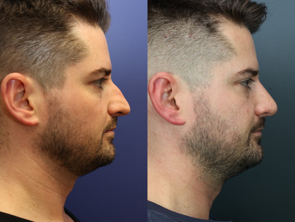 Rhinoplasty (Nose Reshaping) Before & After Gallery - Patient 365233 - Image 5