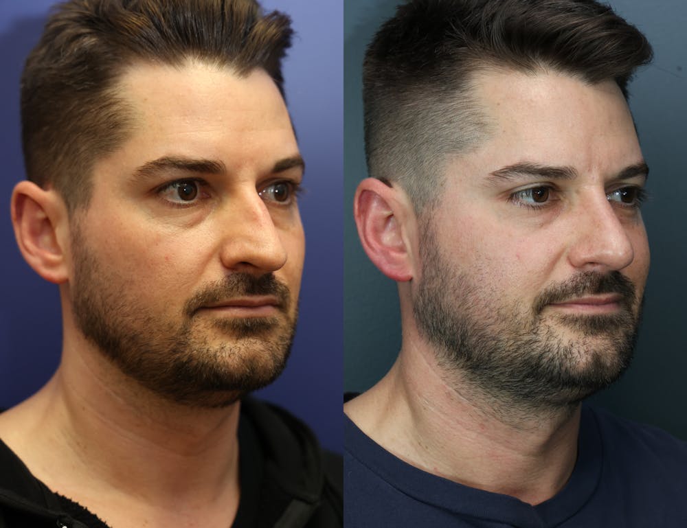 Rhinoplasty (Nose Reshaping) Before & After Gallery - Patient 365233 - Image 4