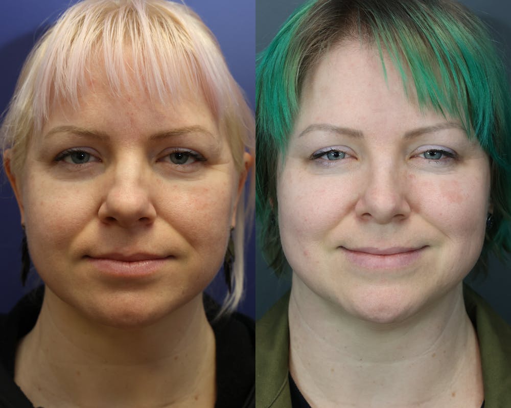 Rhinoplasty (Nose Reshaping) Before & After Gallery - Patient 378971 - Image 3