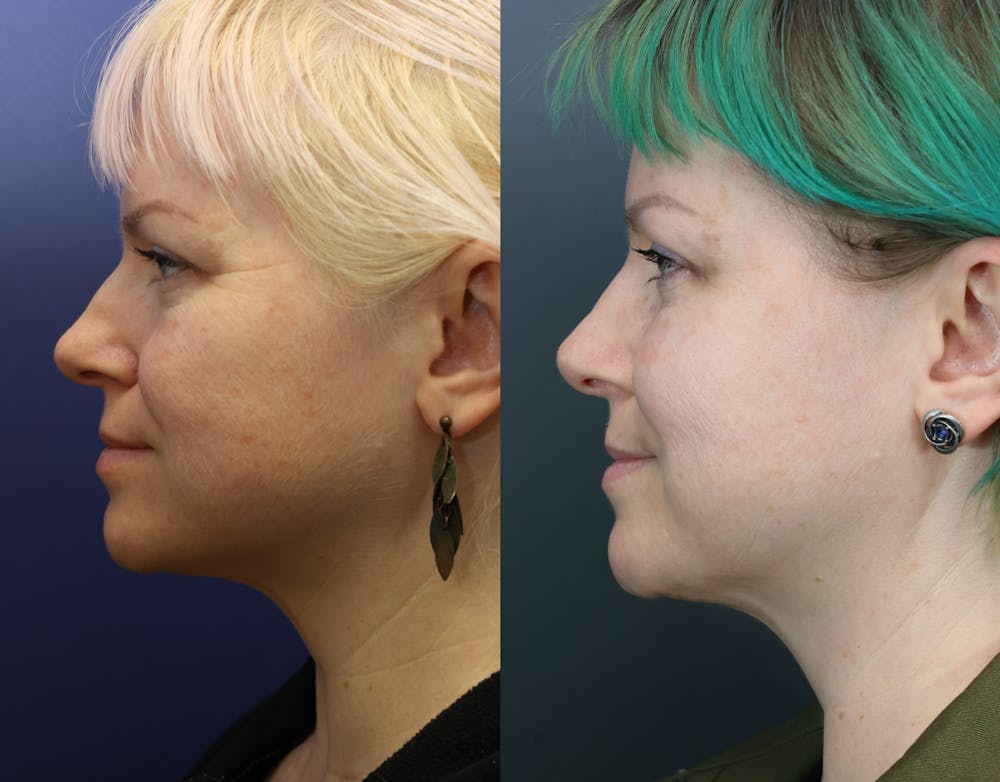 Rhinoplasty (Nose Reshaping) Before & After Gallery - Patient 378971 - Image 4