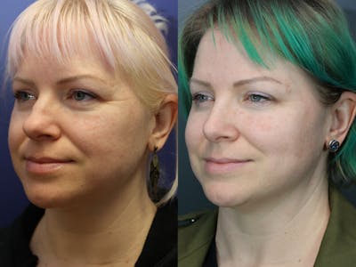 Rhinoplasty (Nose Reshaping) Before & After Gallery - Patient 378971 - Image 1