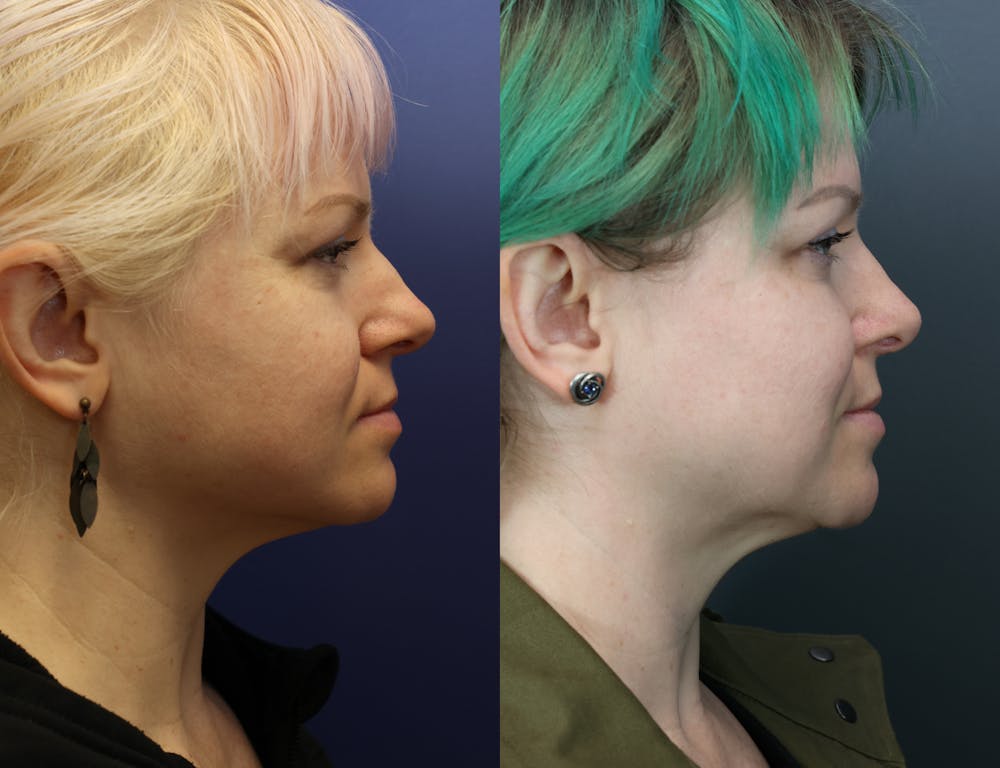 Rhinoplasty (Nose Reshaping) Before & After Gallery - Patient 378971 - Image 5