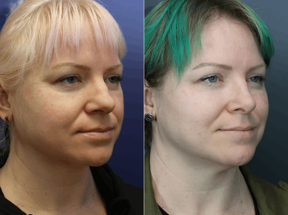 Rhinoplasty (Nose Reshaping) Before & After Gallery - Patient 378971 - Image 2