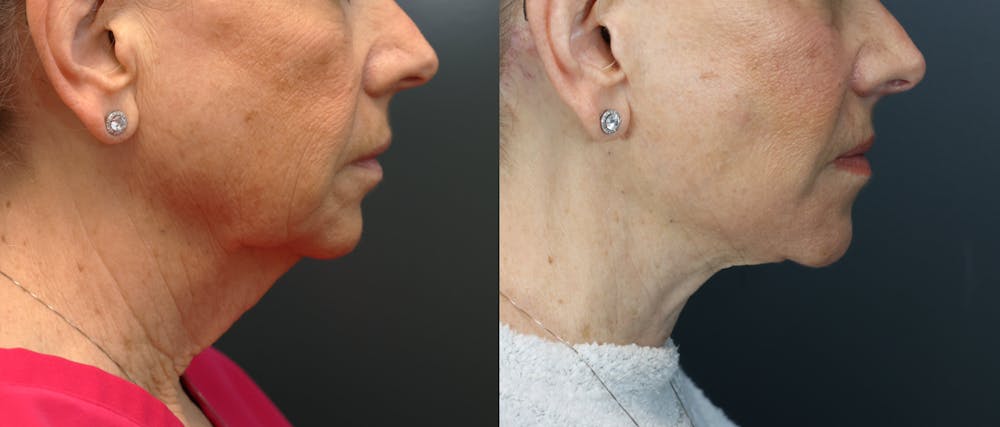Deep Plane Neck Lift Before & After Gallery - Patient 253392 - Image 4