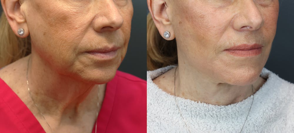 Deep Plane Neck Lift Before & After Gallery - Patient 253392 - Image 5