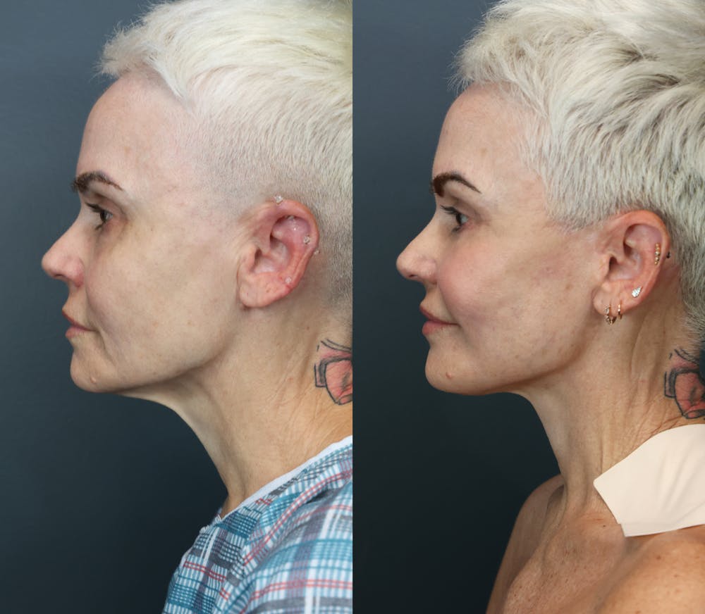 Eyelid Surgery Before & After Gallery - Patient 151400 - Image 3