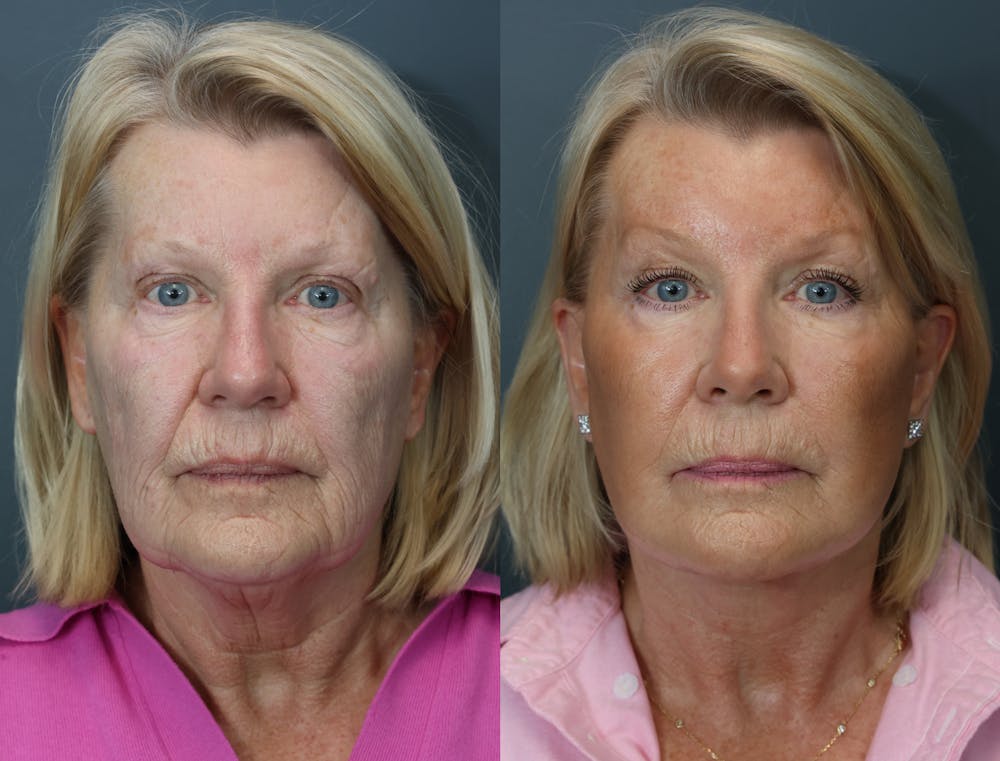 Deep Plane Neck Lift Before & After Gallery - Patient 811280 - Image 1