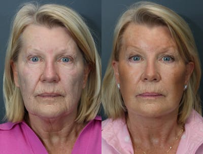 Deep Plane Neck Lift Before & After Gallery - Patient 811280 - Image 1