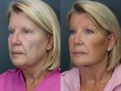 Deep Plane Facelift Before & After Gallery - Patient 248628 - Image 1