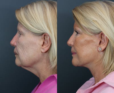 Deep Plane Neck Lift Before & After Gallery - Patient 811280 - Image 2