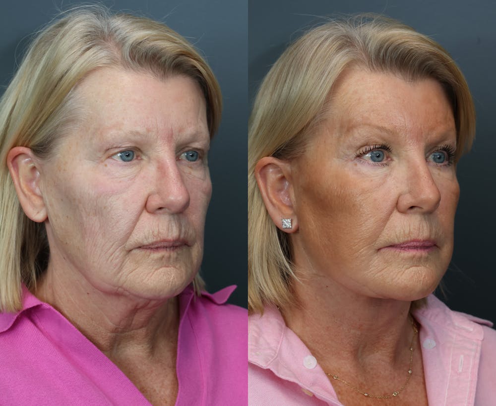 Deep Plane Neck Lift Before & After Gallery - Patient 811280 - Image 5