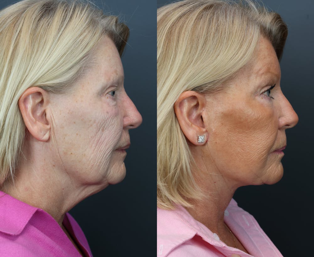 Deep Plane Neck Lift Before & After Gallery - Patient 811280 - Image 3