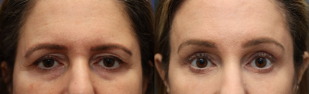 Eyelid Surgery Before & After Gallery - Patient 404099 - Image 1