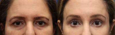 Eyelid Surgery Before & After Gallery - Patient 404099 - Image 1