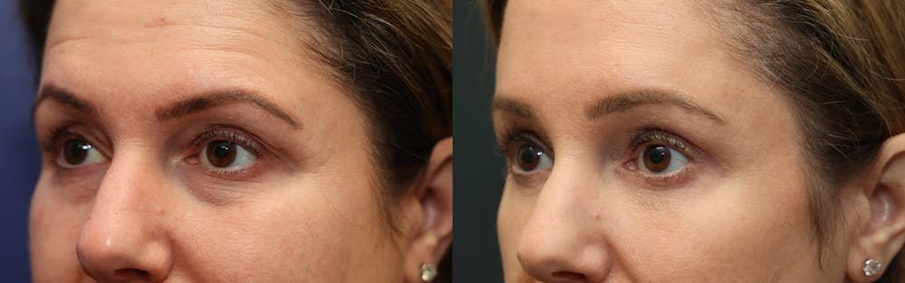 Eyelid Surgery Before & After Gallery - Patient 404099 - Image 3