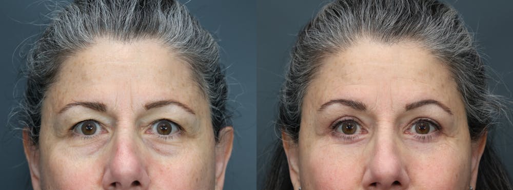 Eyelid Surgery Before & After Gallery - Patient 940831 - Image 1