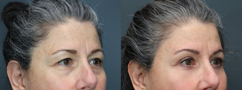 Eyelid Surgery Before & After Gallery - Patient 940831 - Image 3
