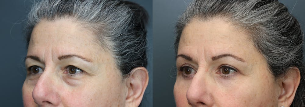 Eyelid Surgery Before & After Gallery - Patient 940831 - Image 2