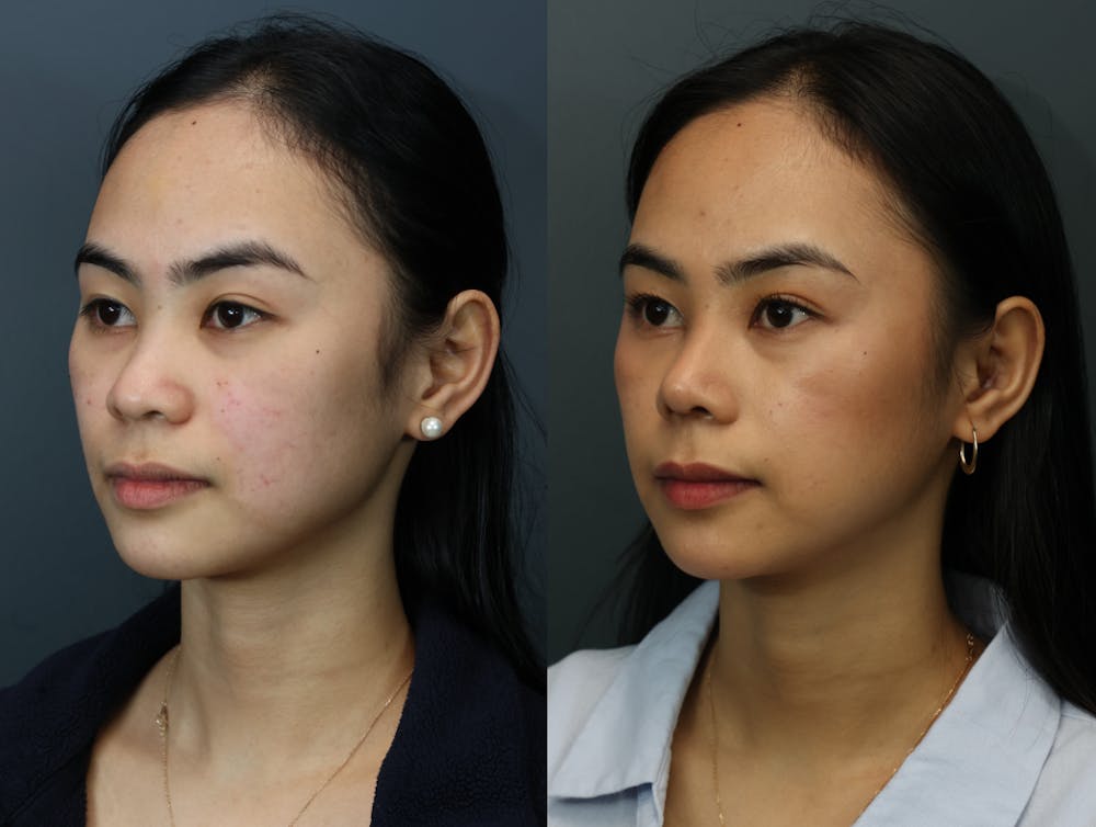 Rhinoplasty (Nose Reshaping) Before & After Gallery - Patient 193927 - Image 2