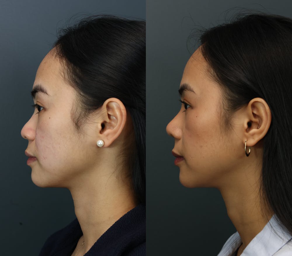 Rhinoplasty (Nose Reshaping) Before & After Gallery - Patient 193927 - Image 4
