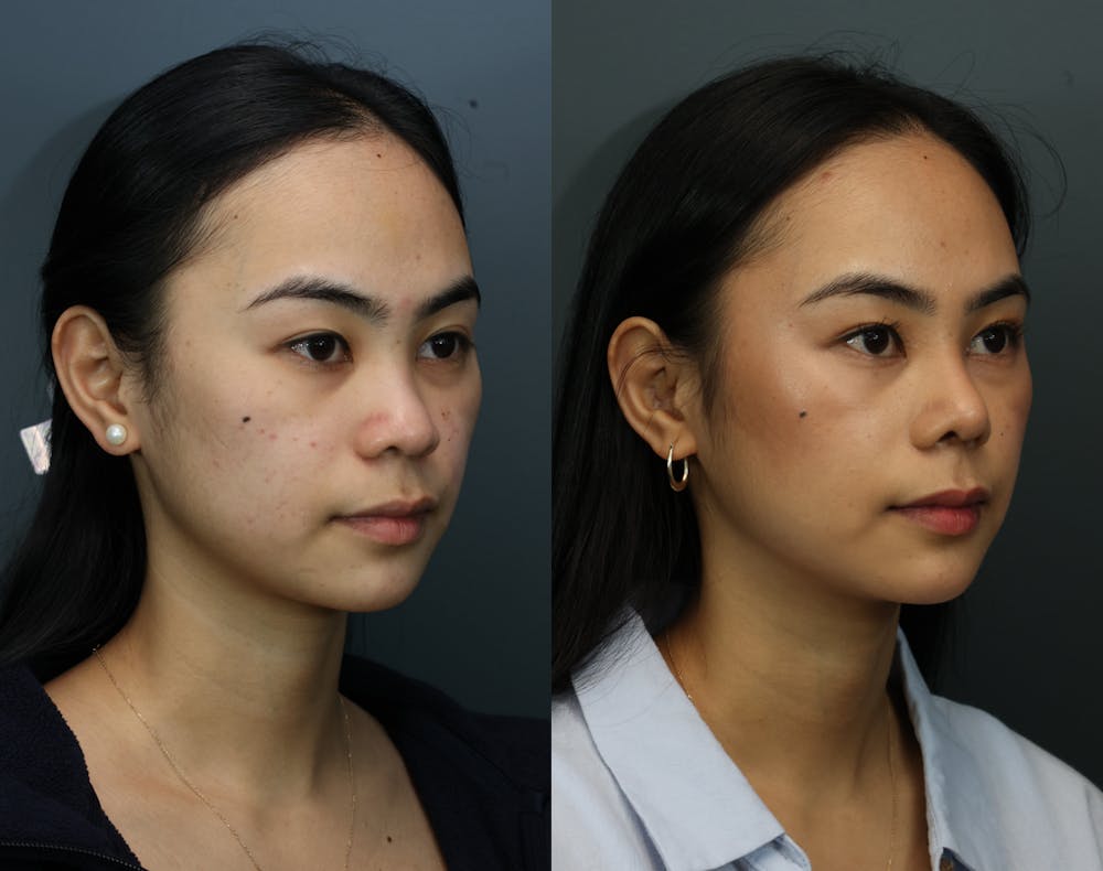 Rhinoplasty (Nose Reshaping) Before & After Gallery - Patient 193927 - Image 3