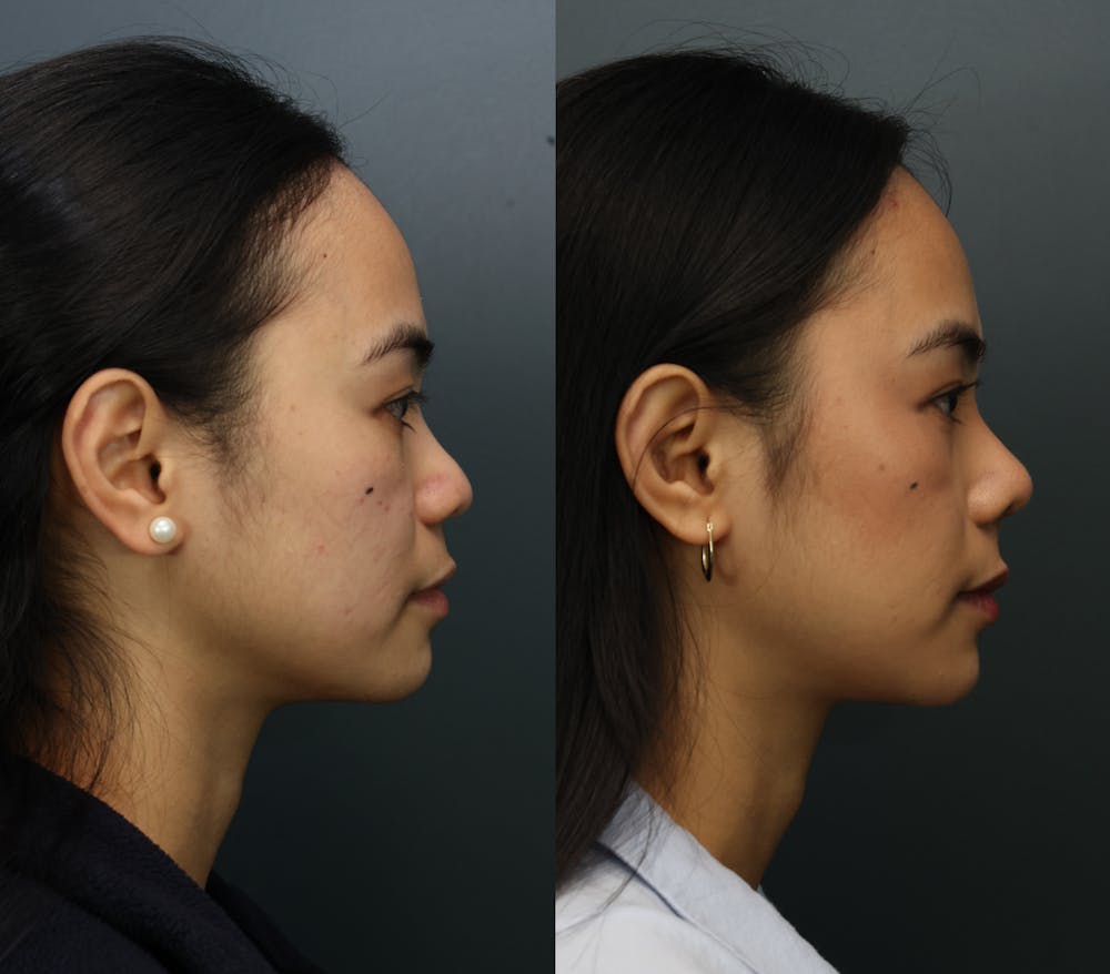 Rhinoplasty (Nose Reshaping) Before & After Gallery - Patient 193927 - Image 5