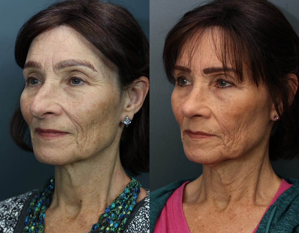 Rhinoplasty (Nose Reshaping) Before & After Gallery - Patient 335659 - Image 2