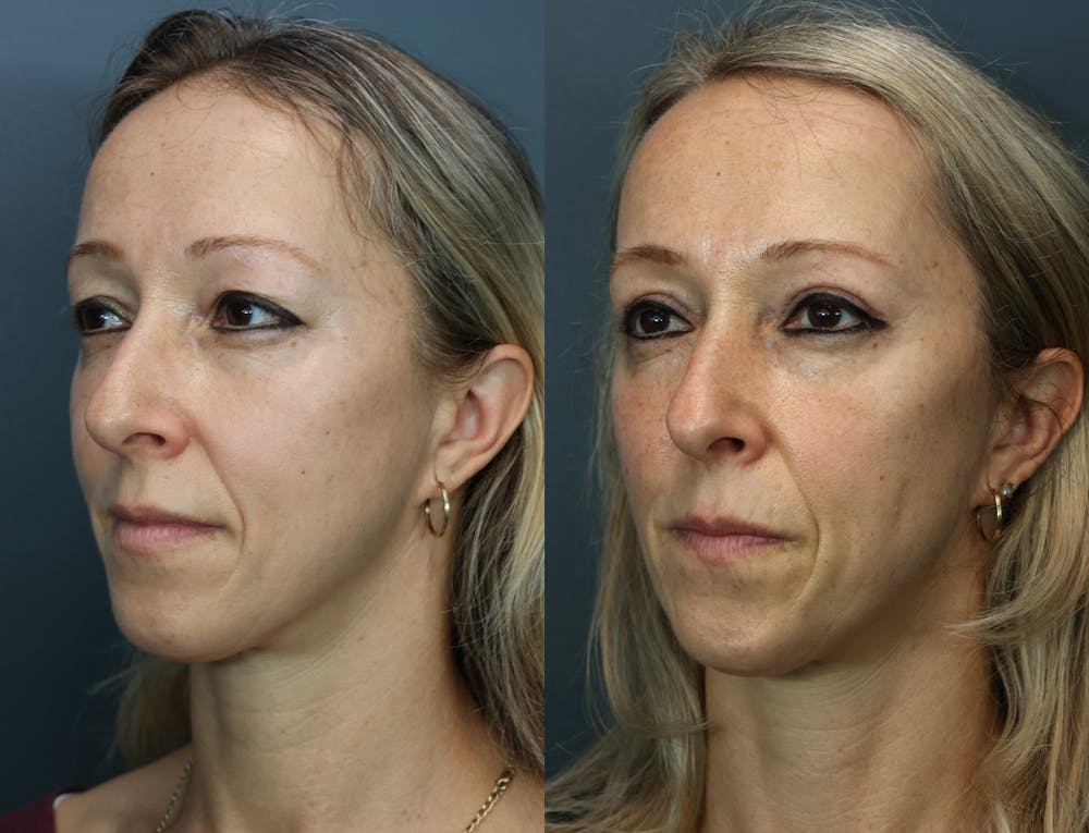 Eyelid Surgery Before & After Gallery - Patient 472565 - Image 2