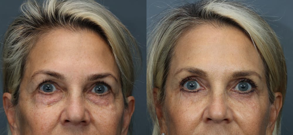 Eyelid Surgery Before & After Gallery - Patient 196155 - Image 1