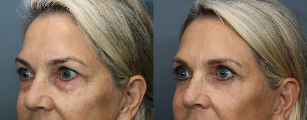 Eyelid Surgery Before & After Gallery - Patient 196155 - Image 3