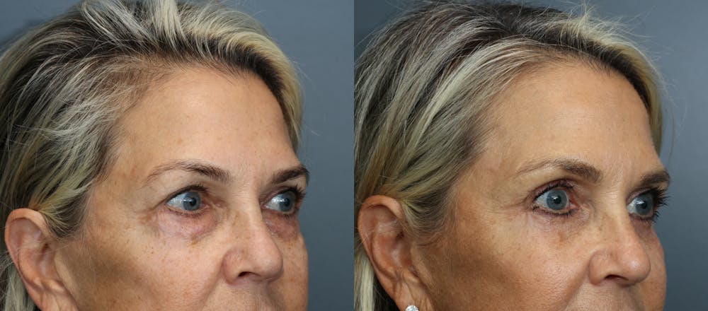 Eyelid Surgery Before & After Gallery - Patient 196155 - Image 2