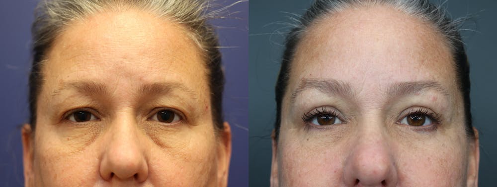 Facial Revolumizing (Fat Transfer) Before & After Gallery - Patient 175171328 - Image 1