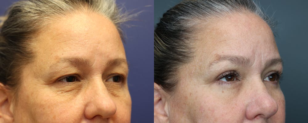 Facial Revolumizing (Fat Transfer) Before & After Gallery - Patient 175171328 - Image 3