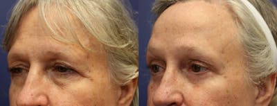 Eyelid Surgery Before & After Gallery - Patient 147104443 - Image 1