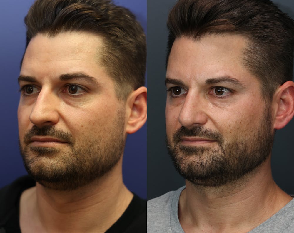 Rhinoplasty (Nose Reshaping) Before & After Gallery - Patient 365233 - Image 2